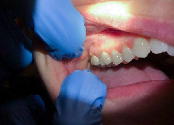 Best Emergency Tooth Extraction in Manchester, TN